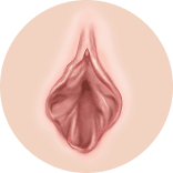 복잡 비대·겹주름·두께 비대가 함께 나타난 소음순 변형 4단계 모식도