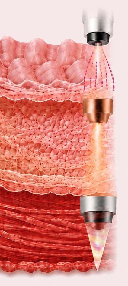 질 점막층·중간층·근육층의 단면과 각 층에 작용하는 Fractional·RF·HIFU 핸드피스를 나타낸 의료 도판