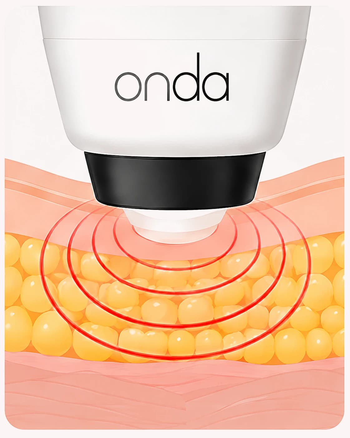 치구 조직 단면에서 ONDA 핸드피스의 고주파가 지방층에 도달하는 모습을 나타낸 도판